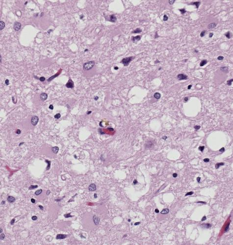 Creutzfeldt Jakob Disease